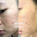 Hình ảnh Thực Tế Review Combo Giảm Mụn Viêm Mủ Biotrade Acnaut - 9Mart.vn