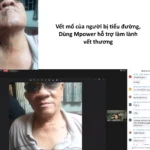 Vết Sẹo Mổ Của Người Bị Tiểu đường Dùng Mpower Hỗ Trợ - 9Mart.vn